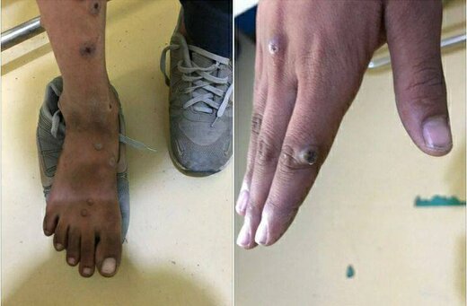 کدام افراد به آبله میمون مبتلا میشوند؟ کدام افراد به آبله میمون مبتلا میشوند؟